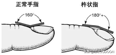 科普！如何自己判断肺部健康程度？试试这5种方法