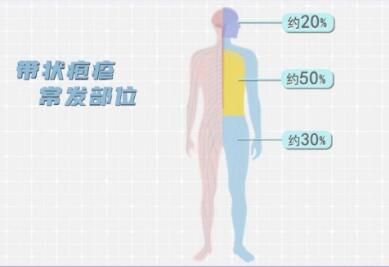 帶狀皰疹常發(fā)部位