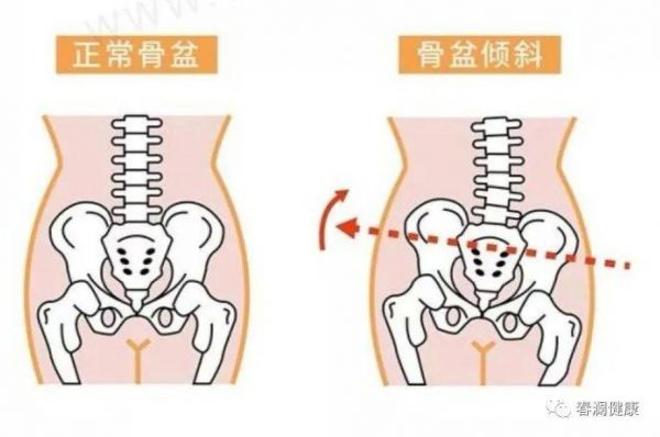 骨盆傾斜
