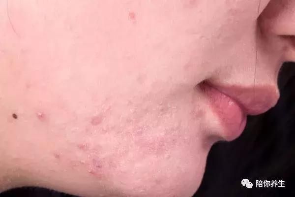 女人子宮好壞 看臉就知道 5個現象說明不健康