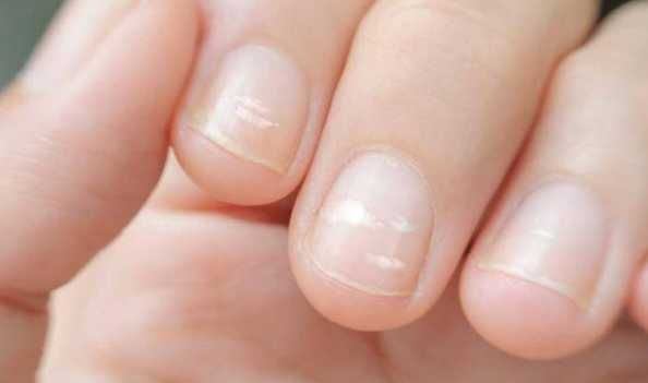 健康的手指甲是什么樣的？如何判斷指甲健康？-第1張圖片