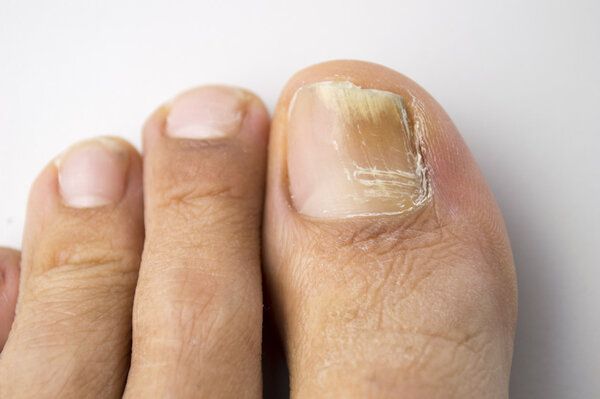 治療灰指甲怎樣保護(hù)肝臟
