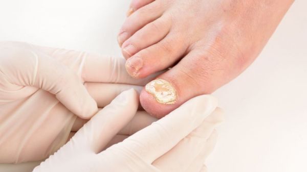 脚趾甲空的原因