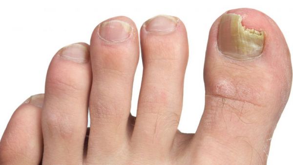 脚趾甲癣的治疗