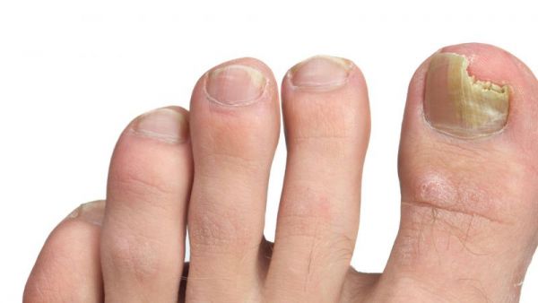 脚趾甲发黄的原因