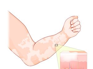 排名考察:貴陽哪里治療白癜風專家好“排名TOP3”他克莫司怎么用