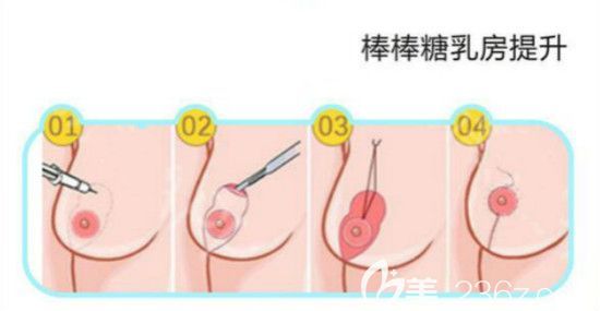 乳房懸吊術(shù)做完的圖片