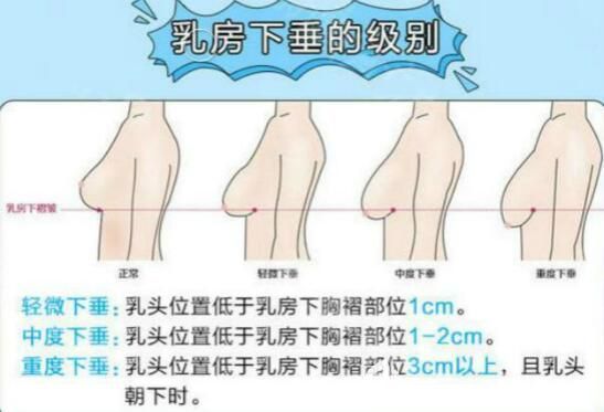 怎樣測量乳房下垂程度的依據(jù)