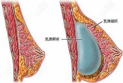 假體隆胸手術(shù)假體置放的部位