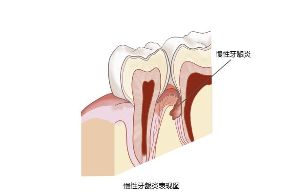 急性齦乳頭炎