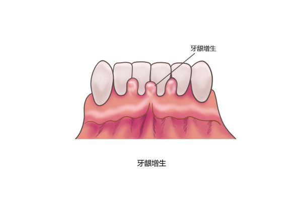 牙齦增生表現(xiàn)圖