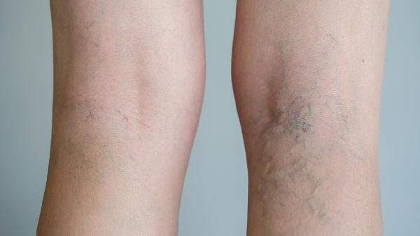 痛风高发，为何40岁左右人群更易“中招”？医生无奈说出背后实情