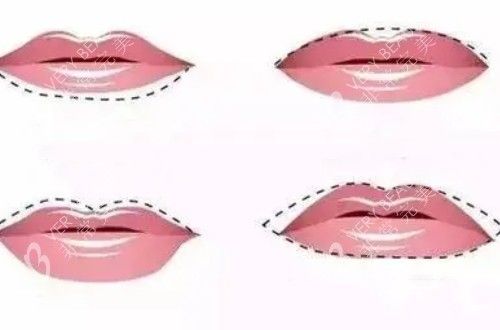 不同唇形問題的調(diào)整方案示意圖