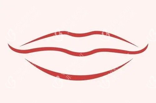 比較受歡迎的微笑唇卡通示意圖