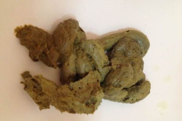 健康正常成人的粪便图