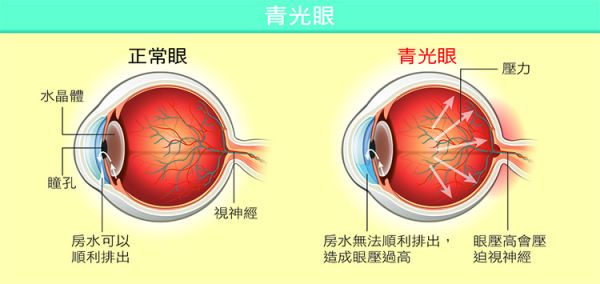 青光眼