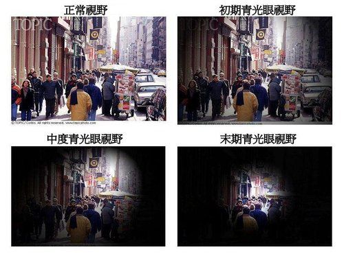 青光眼癥狀(病征)有哪些？