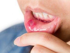 怎么看口腔是否感染hpv
