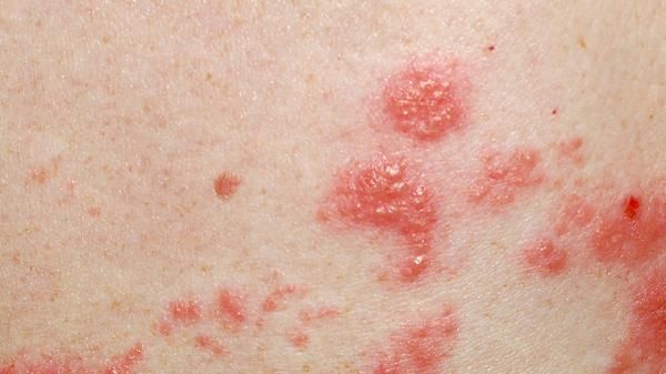 三個(gè)月陰能排除艾滋病嗎