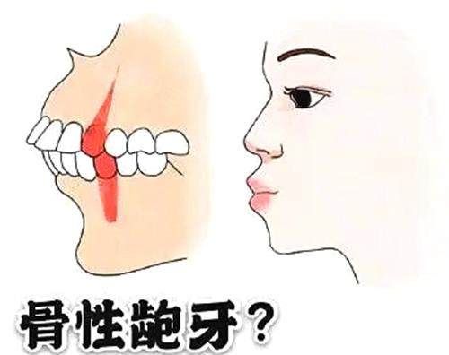 骨性齙牙和齒性齙牙