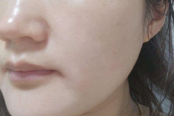 正常皮膚圖片