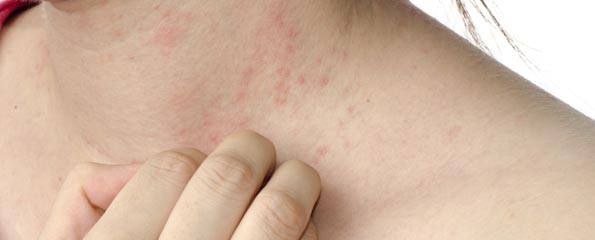 Living well with psoriasis