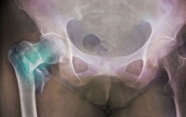 不对劲！上海老伯骨折后肺部感染，反复住院……很多人有这些误区