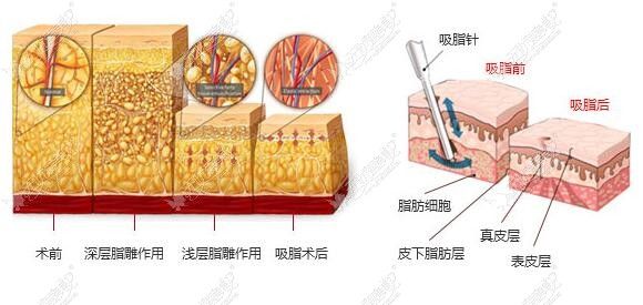 南充華美整形腰腹部分層吸脂緊膚，高效安全，不會(huì)再胖噢!