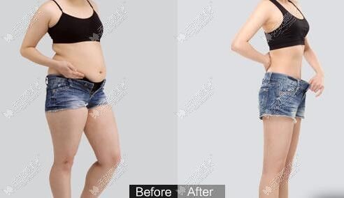 南充華美整形腰腹部分層吸脂緊膚對比效果案例圖