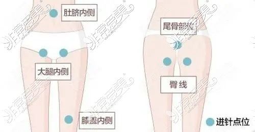 吸脂進針
