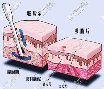 吸脂減肥前后