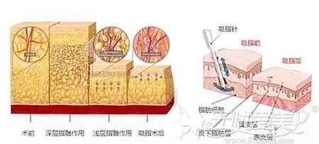 腰腹部吸脂的原理