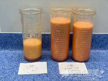 腰腹部吸脂一次建議800-400ml