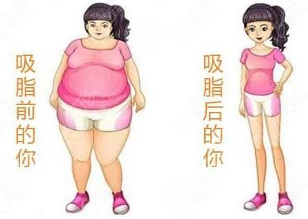 北京靚顏時尚醫(yī)療美容診所腹部吸脂后2周
