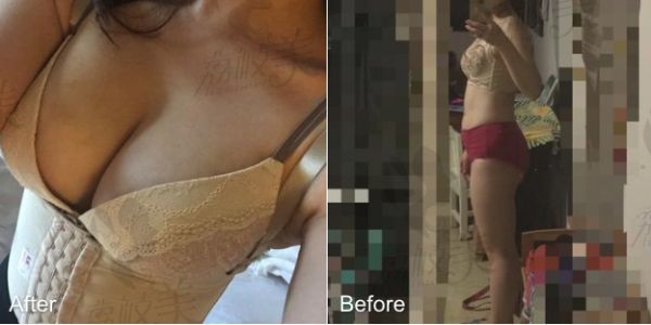 北京純脂醫(yī)療美容門診部自體脂肪隆胸