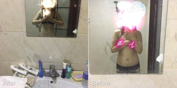 北京純脂醫(yī)療美容門診部吸脂瘦腰腹