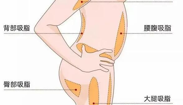 腰腹吸脂動漫13.jpg