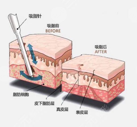 影響抽脂手術(shù)價(jià)格的因素有哪些?