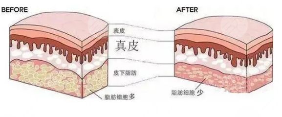 抽脂手術(shù)都有哪些危害?