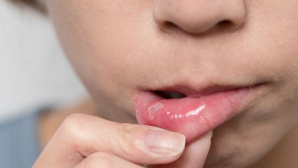 口腔潰瘍老不好？醫(yī)生：口腔出現(xiàn)這些異常，多半是口腔癌“信號”