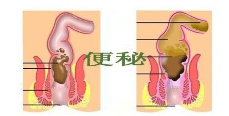 便秘，符合哪几条，就需要手术治疗了？