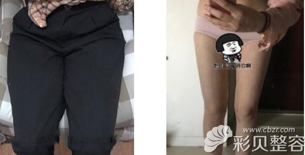 純脂大腿抽脂和腰腹吸脂前后對比照片