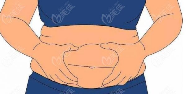 王世虎腰腹抽脂实例