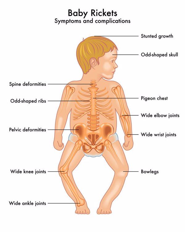 幼儿夹腿综合征的症状和危害表现