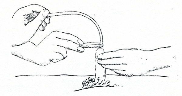 重度等滲性脫水如何補(bǔ)液