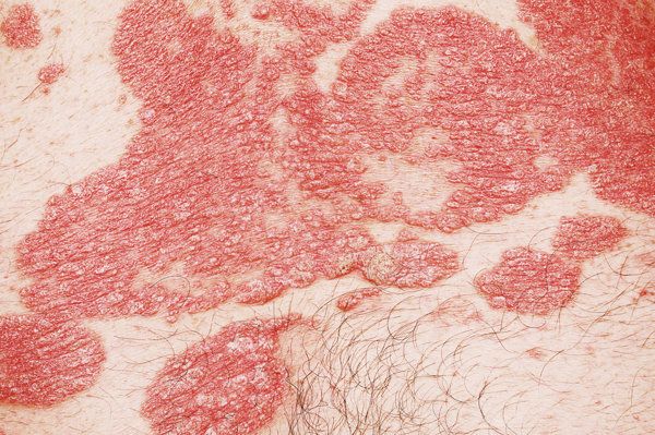 锻炼出汗治好了牛皮癣 锻炼出汗是不是脂肪燃烧