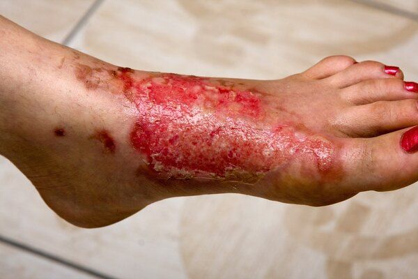 減肥針灸用什么牌電熱毯