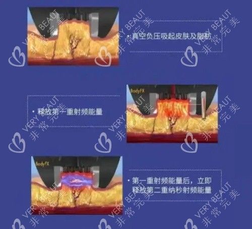 鉆石超塑整形的優(yōu)勢示意圖