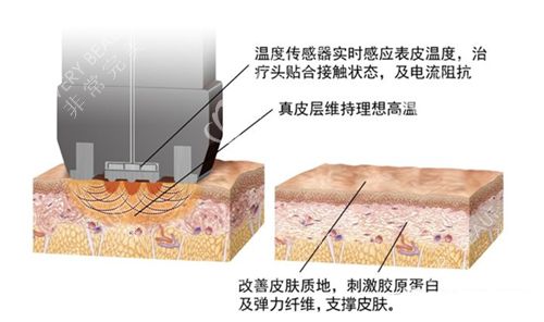 鉆石超塑的作用