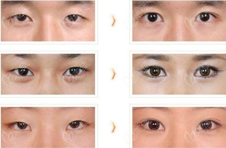 韓國(guó)清潭FIRST城鎮(zhèn)模院長(zhǎng)自然風(fēng)雙眼皮實(shí)例